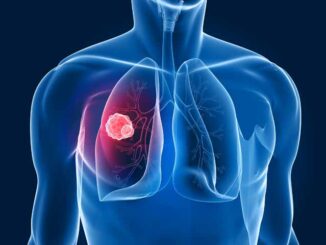 Screening del cancro al polmone, Monaco lancia una nuova campagna