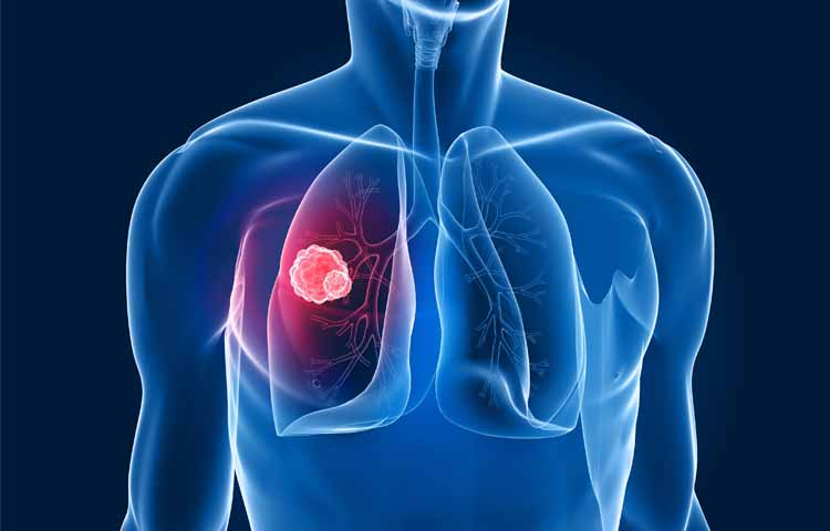 Screening del cancro al polmone, Monaco lancia una nuova campagna